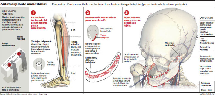 Autotransplante Mandibular