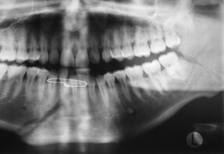 Treatment of Edentulous Mandibular Fractures with Rigid Internal Fixation